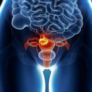 El cáncer de cuello uterino es el cuarto tumor maligno más frecuente en mujeres en todo el mundo.