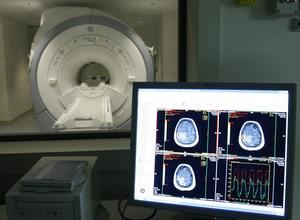 Descubren una nueva alteración en el cerebro de las personas con Alzheimer