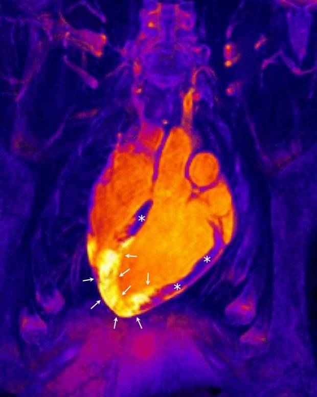 Imagen de resonancia magnética tridimensional en un sujeto tras un infarto agudo de miocardio. En el centro de la imagen aparece el corazón; el músculo cardiaco sano (no infartado) está marcado con asteriscos, mientras que las flechas señalan la región de corázon que ha sufrido el infarto. CNIC.