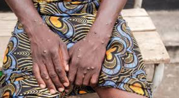 La OMS pide una ayuda de 135 millones de dólares para frenar los brotes de mpox en África.