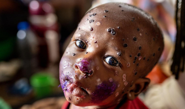 El segundo premio del Fondo de las Naciones Unidas para la Infancia (UNICEF) recayó en la imagen del fotógrafo francés Pascal Maitre para 'Paris Match', sobre la enfermedad vírica mpox.